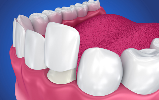 What Are Dental Crowns