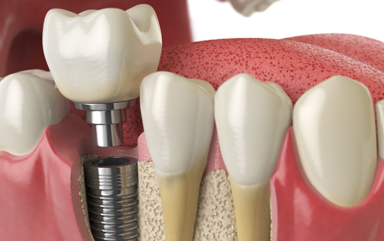 Who Is A Good Candidate For Dental Implants