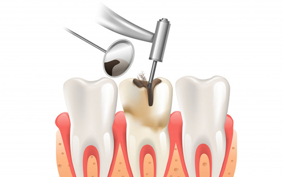 Who Is A Good Candidate For Root Canals