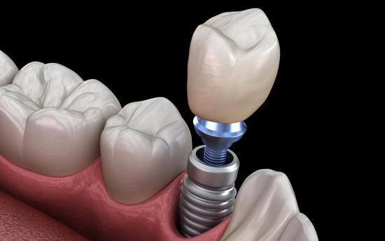 Why Are Dental Implants Needed