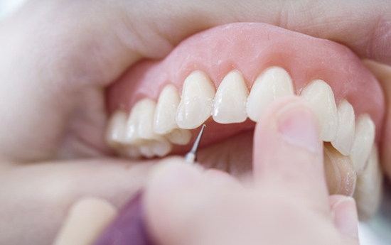 What Happens During The Procedure For Implant Supported Dentures