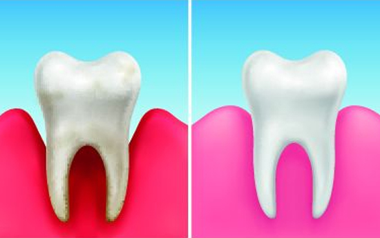What Is Gum Periodontal Treatment