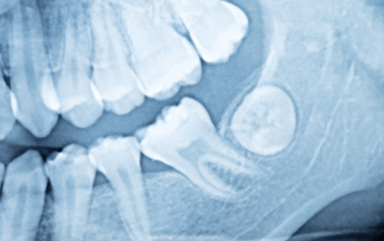 Who Is A Good Candidate For Wisdom Teeth Removal