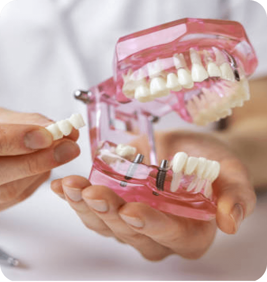 Dental Implants Humble Memorial Dental Group