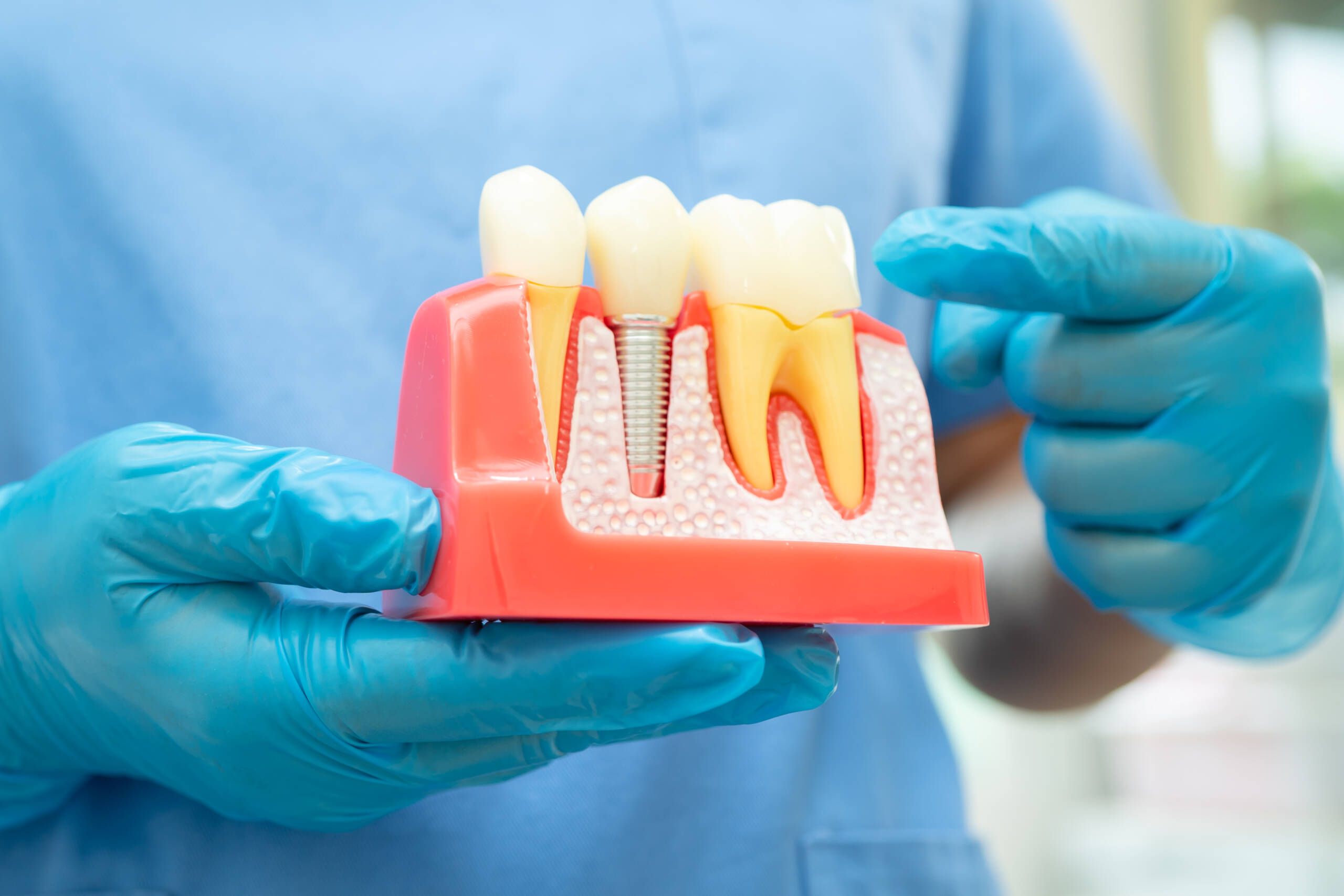 Most Googled Questions About Dental Implants (Expert Answered)