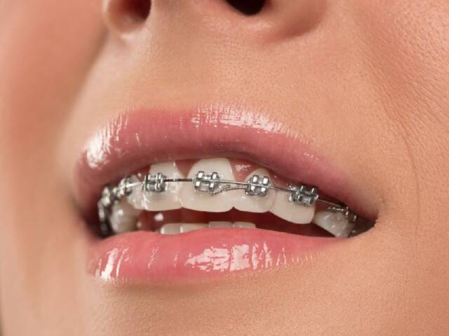 Are Braces Painful?