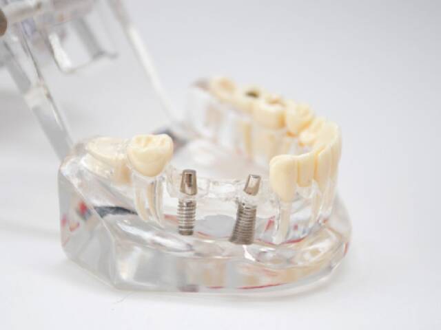 What Is a Dental Implant Abutment?