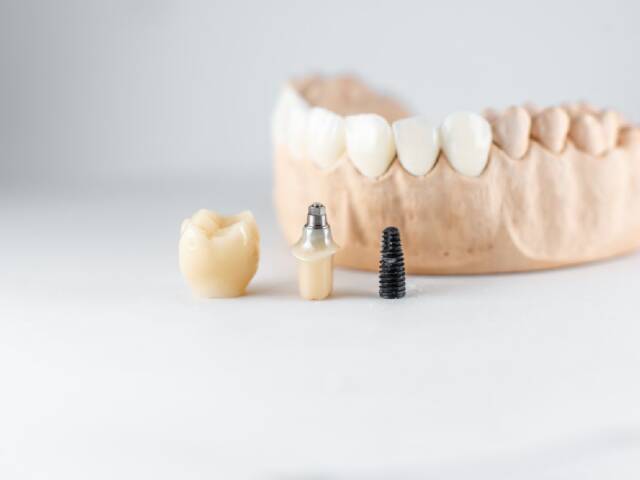 What is a Dental Implant?