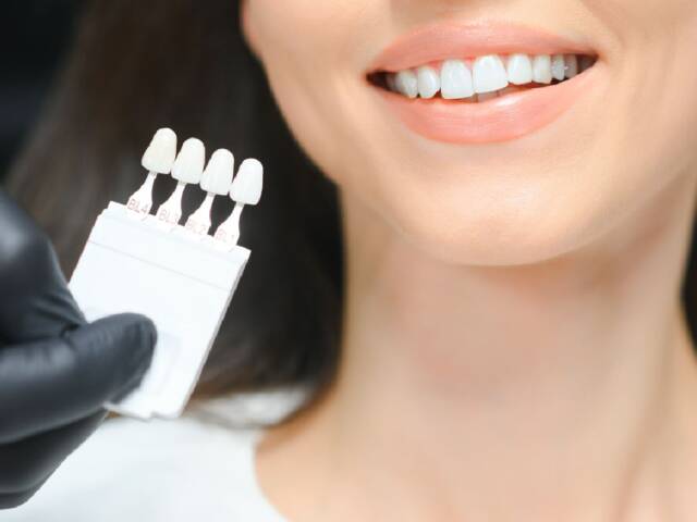 Are Veneers Expensive?